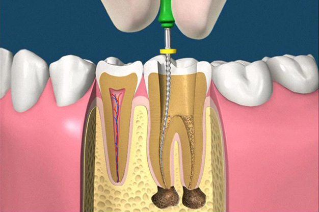 Endodonzia Endodonzia